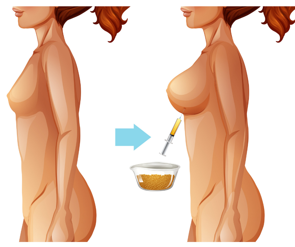 BeautiFill-Non-Surgical-Fat-Transfer-Breast-Lift