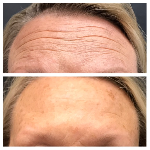 Botox