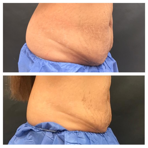 Cellulite and Fat Reduction & Body Contouring BEFORE & AFTER 12