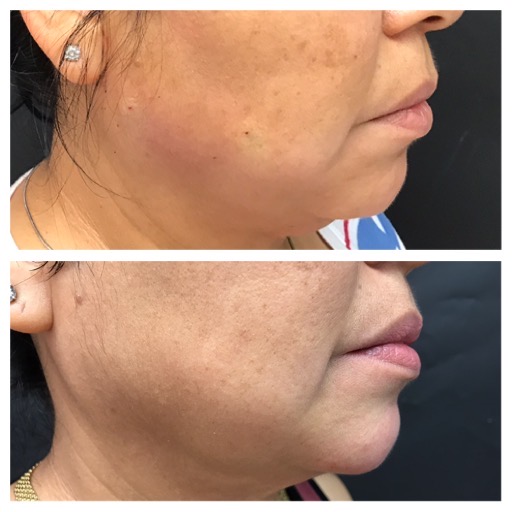 Chin augmentation