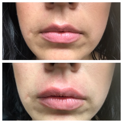 Dermal fillers