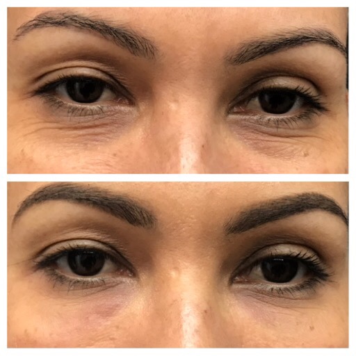 Dermal fillers