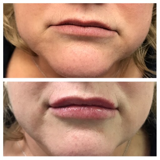 Dermal fillers