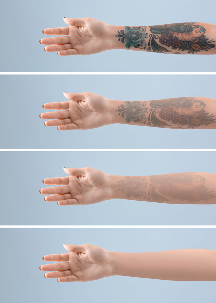 Laser Tattoo removal