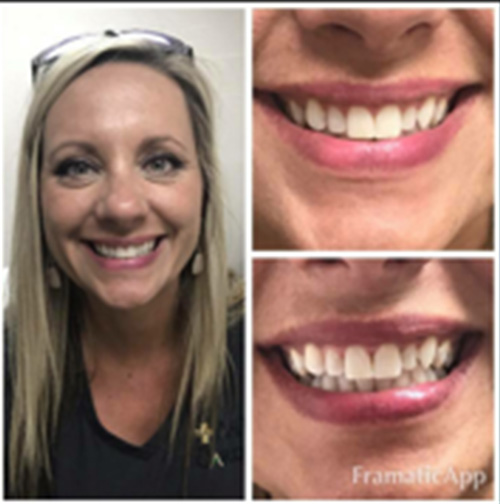 Laser Teeth Whitening