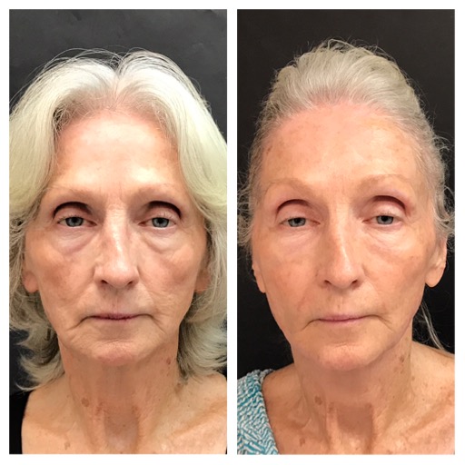 ViVi Nonsurgical Facelift