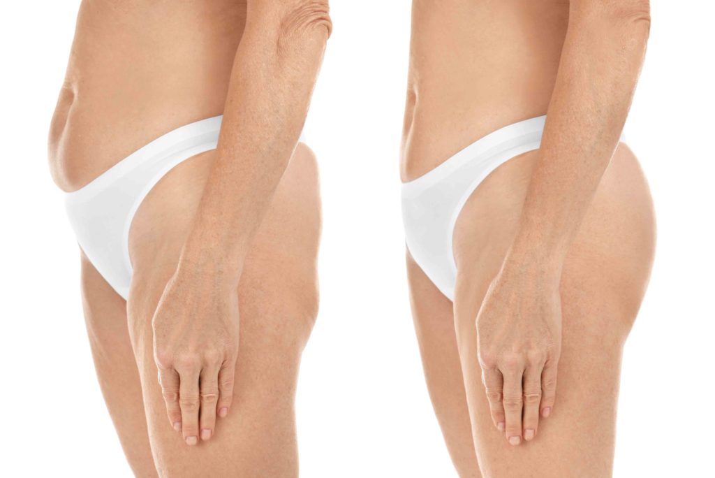 Mature woman body before and after liposuction. Plastic surgery