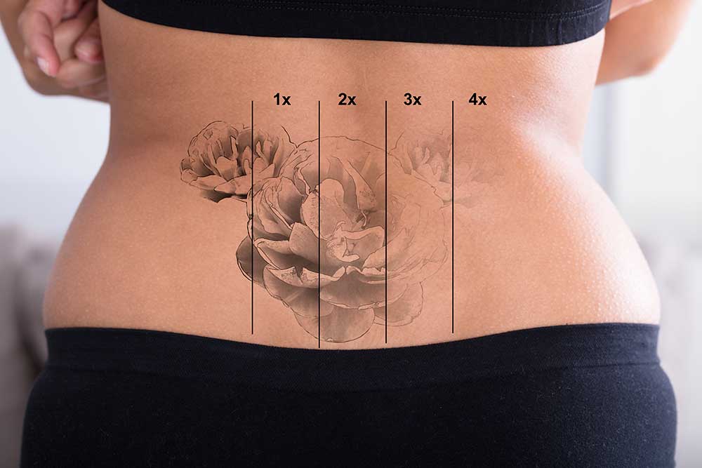 tattoo-removal