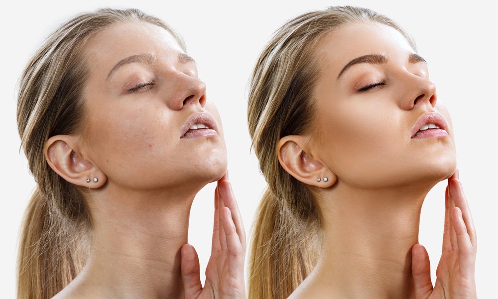 Exosomes Facial Rejuvenation