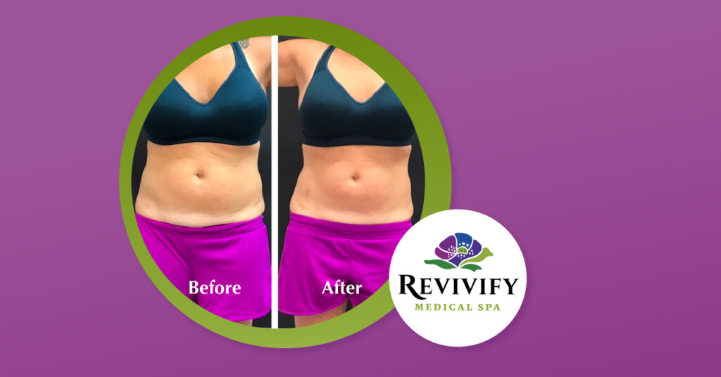 BTL Vanquish ME Body Contouring Special