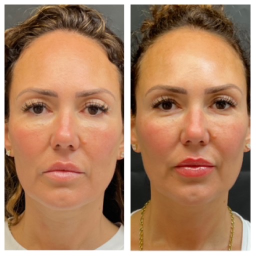 Customized Facial Rejuvenation