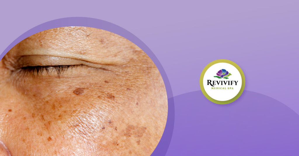 Best Melasma Treatments Hyperpigmentation/Melasma Awareness Month