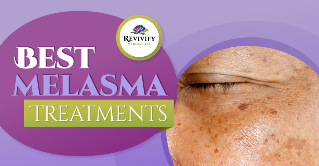 Best Melasma Treatments Hyperpigmentation/Melasma Awareness Month