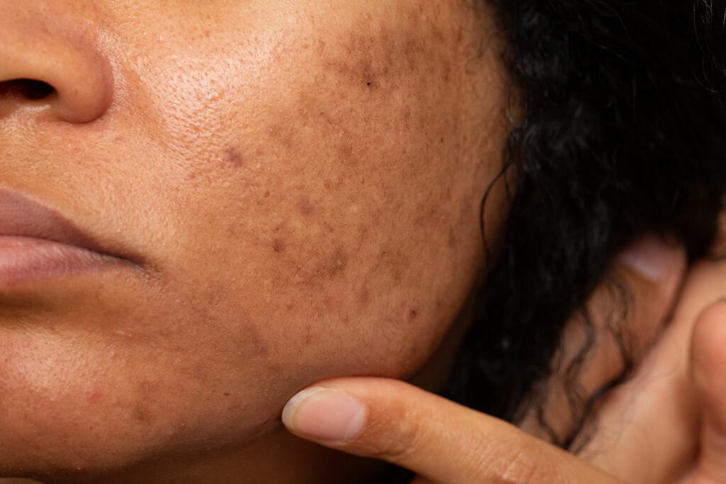 Best Melasma Treatments what it is