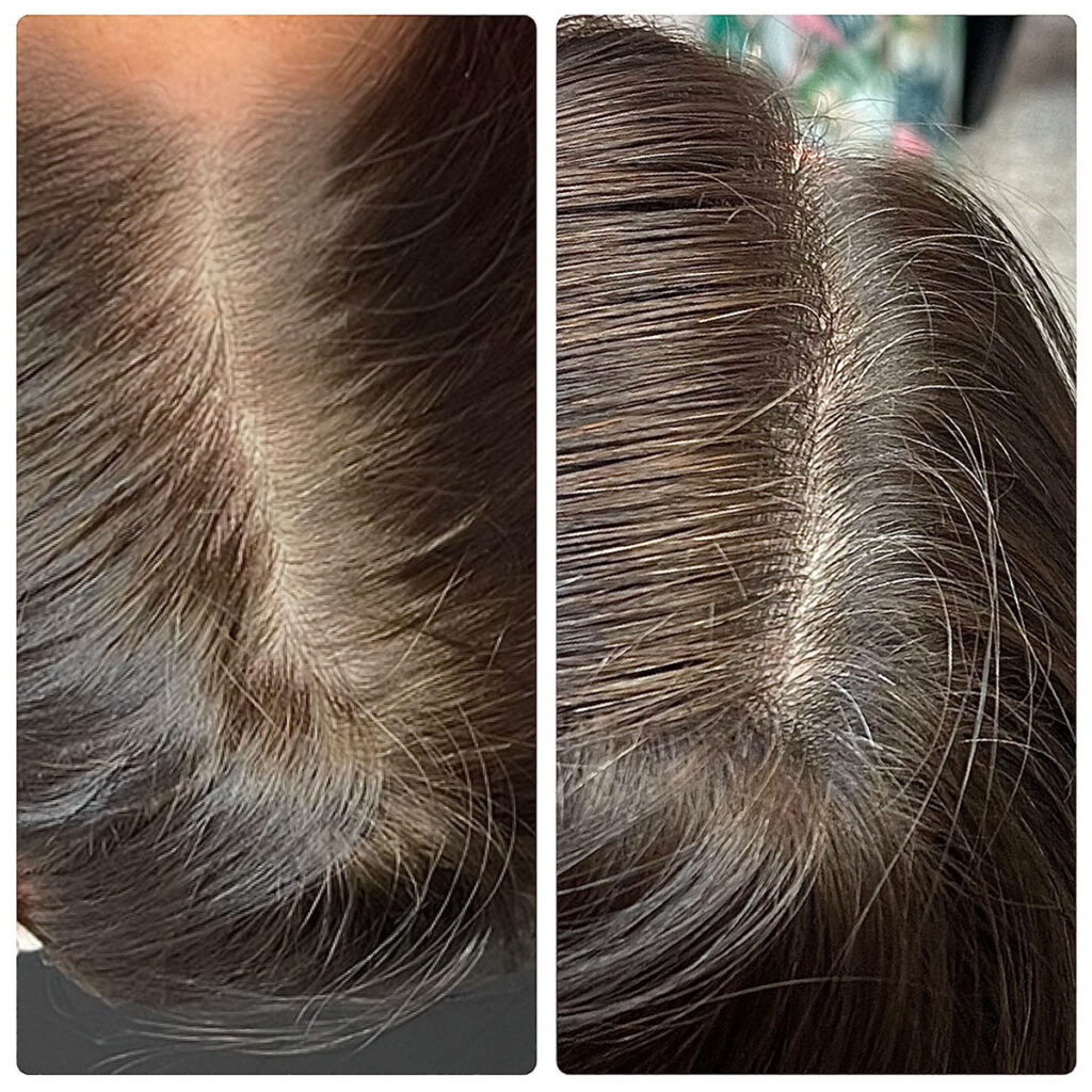 ALMA hair restoration
