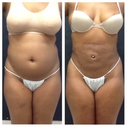 Beautifill results